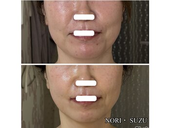 ノリスズ(NORI SUZU)/骨格小顔術×レッドショット3cc