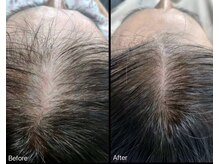 マーブル 熊本合志店/育毛促進【女性　分け目】