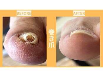 ウォーク イオンスタイル東淀川(WALK)/巻いた爪ケア/BSスパンゲ/巻き爪