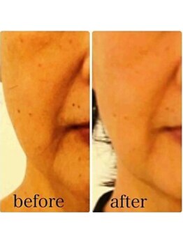 ブランシェ 金沢店 × 椿/シワ・たるみケア　お客様