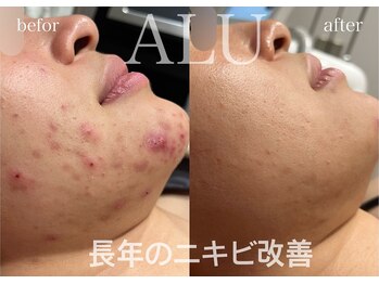 アルフォービューティー 恵比寿店(ALU for beauty)/慢性ニキビ改善症例