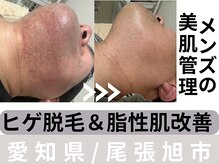 サロン イナンナ(Salon INANNA)/メンズのヒゲ脱毛♪