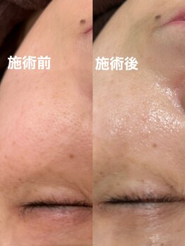 ツール(TOOL)/ハーブピーリング