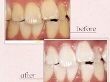 ルアナシンフォニア エクシア 恵比寿店(Luana-Sinfonia)/ホワイトニングビフォーアフター