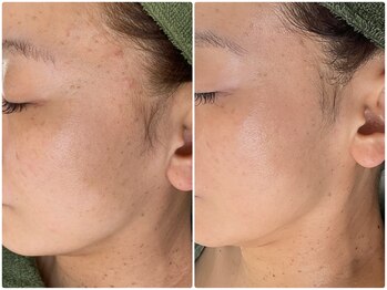 ルミエール フォレストサイド(L’MIERE forestside)/肌老化にヒト幹細胞培養液ケア