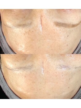 ビー ブルーム(B BLOOM)/【プラズマ】深いシワ改善