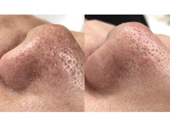 ティーナ(Teena)/毛穴洗浄