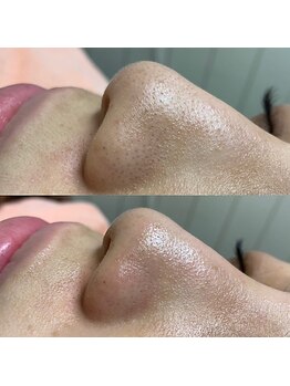 シンディー(CINDY)/毛穴洗浄