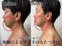 アンドエス 六本木(and S.)/フェイスラインのたるみに♪