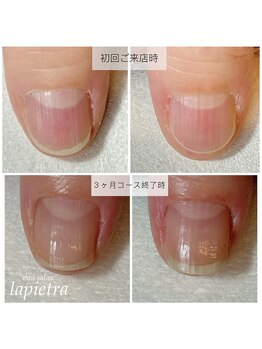 ネイルサロン ラピエトラ(la pietra)/最強のネイルケア３ケ月間コース