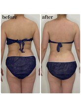 カプリス(CAPRiCE)/リンパドレナージュ