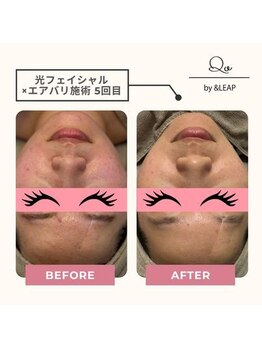 キュオバイアンドリープ(Qo by &LEAP)/光フェイシャル×エアバリ