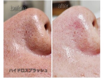 アンカシェット(en cachette)/ハイドロピーリング