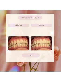 プラスビー 2号店(+b)/ホワイトニングビフォーアフター