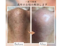長年のお悩みしっかりケア！詰まりの無い引き締まった毛穴へ