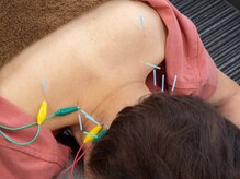 頑固な頭痛、肩こりにも鍼灸で一撃！効果抜群！