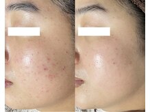 ザ プレザント 大倉山(the pleasant)の雰囲気（ニキビケア5回目の症例写真です。ニキビケアはお任せください!!）