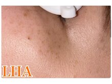 ベルフィオーレ(bel fiore)/30代女性　初回Before