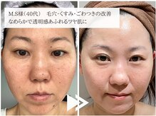 レイテノール 藤沢店/子育てママさんの肌質改善