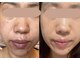ロイヤル ビューティー サロン(Royal Beauty Saloon)の写真/【韓国セルマンで肌質管理×ピーリング】美白ケア効果◎ナイアシドアミド配合水分量UP!ハリや艶玉肌を実現
