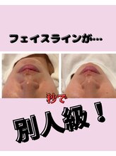 ミライ(Mirai)/たったの1時間で小顔へ