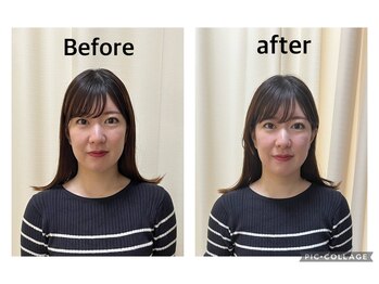 まごころ整骨院/美容鍼Before&After（1回施術）