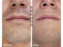 CDF 赤坂/メンズヒゲ脱毛10回目初回￥1000