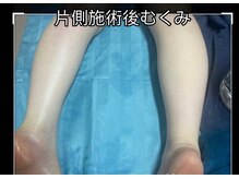 ニコニコ養生堂/施術後むくみをしっかりとれます