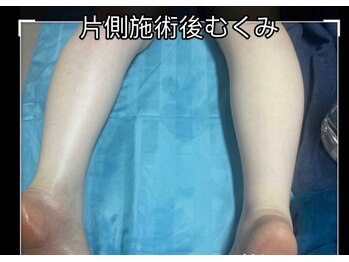 ニコニコ養生堂/施術後むくみをしっかりとれます