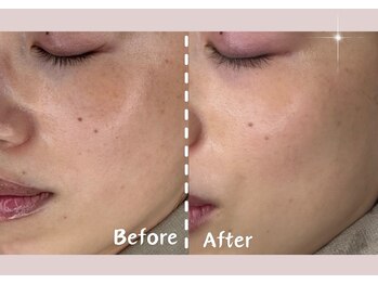 シー センター北(sii)/フォト美顔×３回