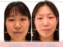 アメリイ 百合ヶ丘 新百合ヶ丘(Amerii)/小顔６回30代リフトアップ透明肌