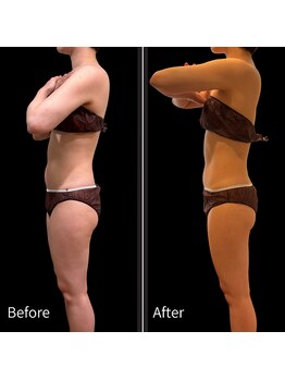 クールヴィラ(Cool Villa)/腹部4カップ×2回+電磁パルス