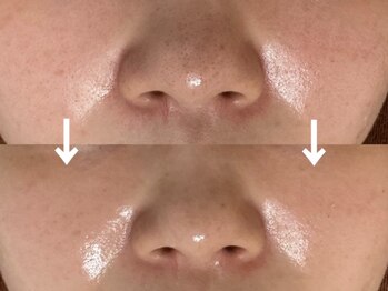 スキニティ(Skinity)の写真/【肌管理専門店★諦める前にお任せください!】セラピール/ハーブピーリングで内側から輝く美肌へ♪