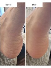 ケアプラス(care plus)/足裏角質ケア