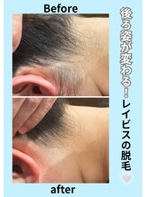 エステティック レイビス 青森店(RAYVIS)/うなじ脱毛で首が長く細見え！