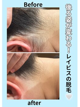 エステティック レイビス 青森店(RAYVIS)/うなじ脱毛で首が長く細見え！