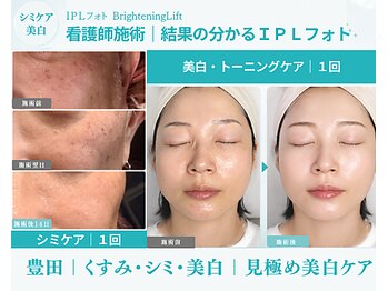 ドアディ(Doordie)の写真/【看護師診断】シミの深さを見極めたシミケア・美白・くすみケア!11枚のフィルターを使い分けるIPLフォト