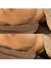 アトリエ ハルミナ(atelier harumina)/もみあげスッキリ★ワックス脱毛