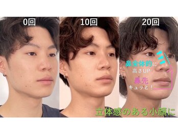 ラプリアンジュ 鹿児島天文館店(Raplit ange)/隆鼻+輪郭矯正40分20回