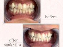 ルアナシンフォニア エクシア 恵比寿店(Luana-Sinfonia)/ホワイトニングビフォーアフター