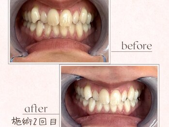 ルアナシンフォニア エクシア 恵比寿店(Luana-Sinfonia)/ホワイトニングビフォーアフター