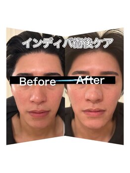 ケイビューティ(k-beauty)/インディバフェイシャル