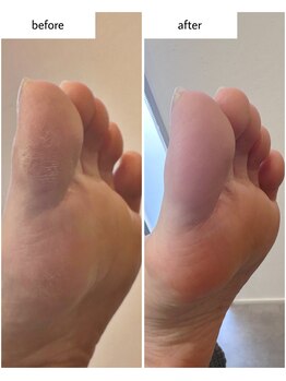 ケアプラス(care plus)/足裏角質ケア