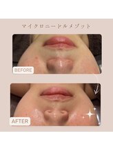 エステティックサロン シーズ/★マイクロメゾット4回の効果★