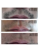 ウルル(Ululu)/【メンズ脱毛】髭脱毛2回目