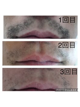 ウルル(Ululu)/【メンズ脱毛】髭脱毛2回目