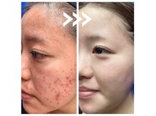 グリッター(GLITTER)