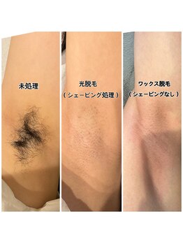 ルーム303(Room303)/脇脱毛/光脱毛/ワックス脱毛