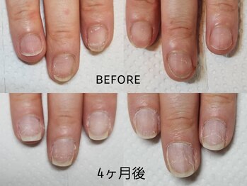 プリンセスネイル(Princess nail)/深爪矯正4週間