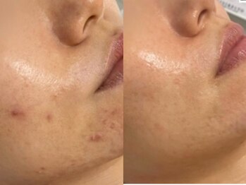 ホーミー(Homie)/ニキビ改善、赤みニキビ改善